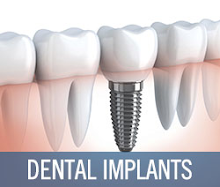 Dental Implant Specialist